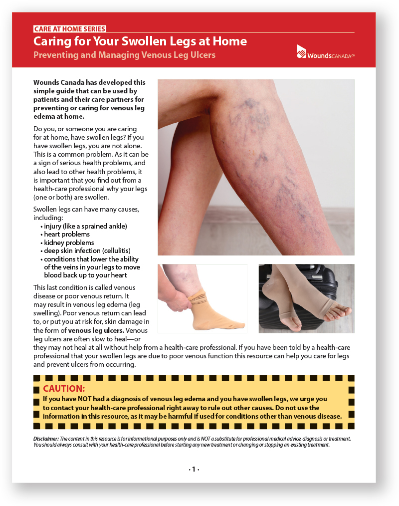 Preventing and Managing Venous Leg Ulcers
