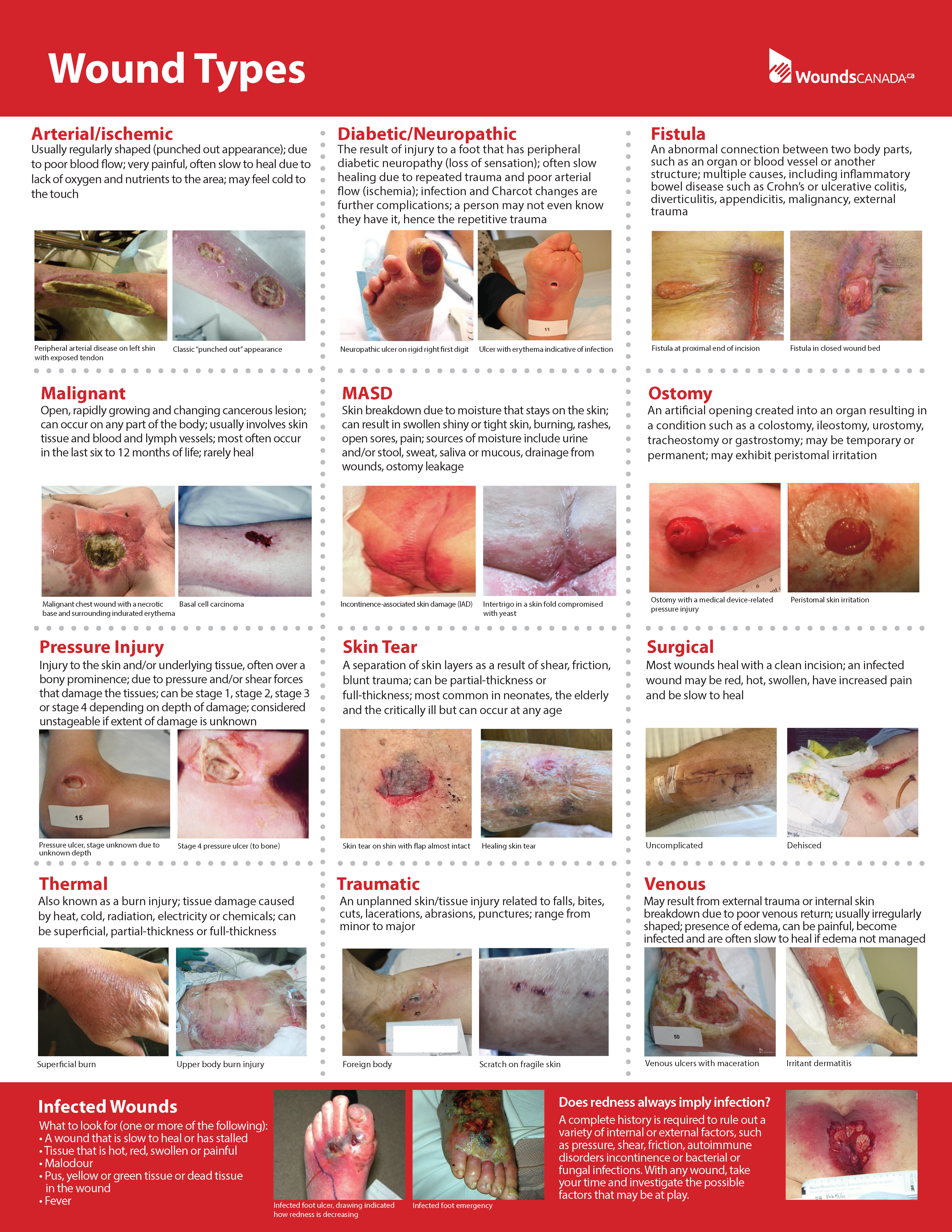 Wound Types Poster
