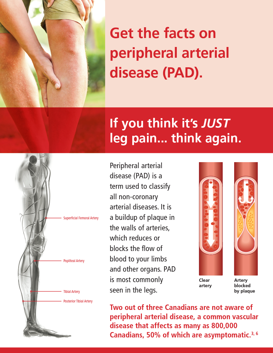Facts on Peripheral Arterial Disease (PAD) for Physicians
